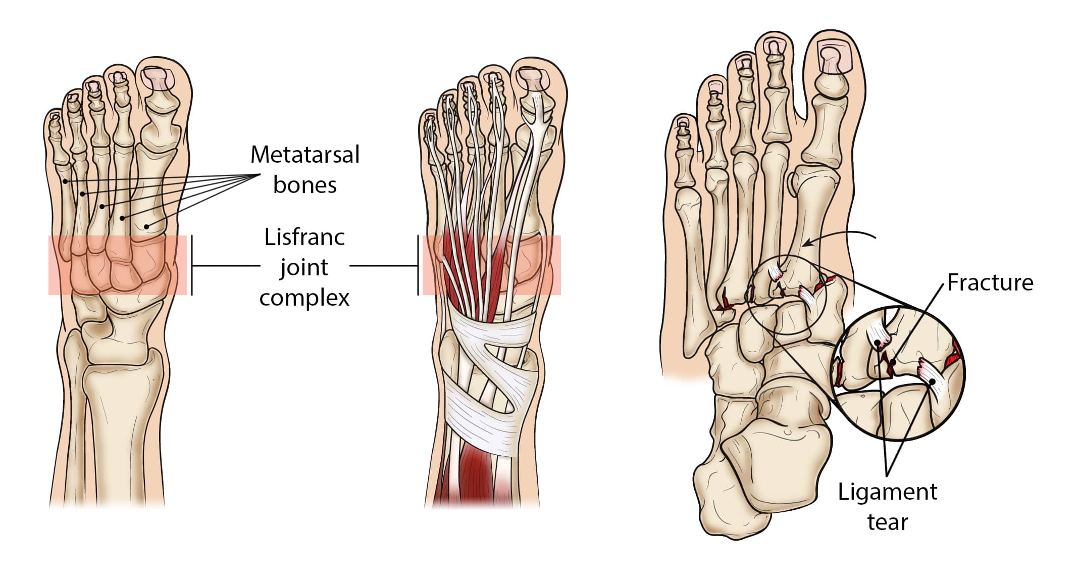  when there are either torn ligaments or broken bones in the midfoot area of one or both feet