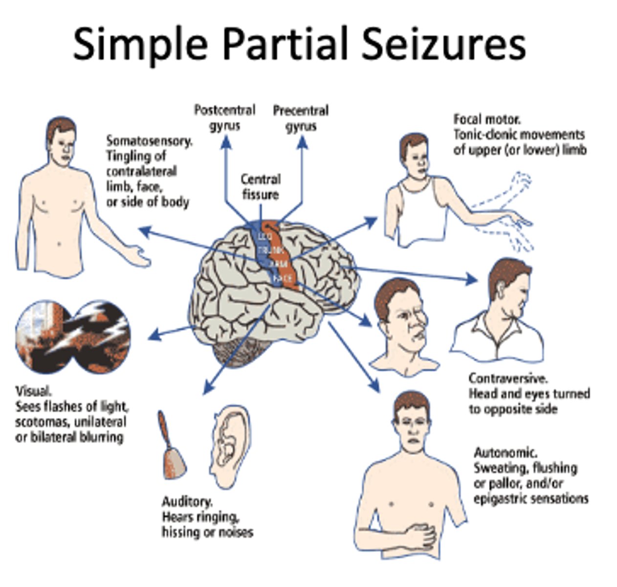 <p>a partial seizure, starting from a focus and remaining localized, that does not produce loss of consciousness</p>