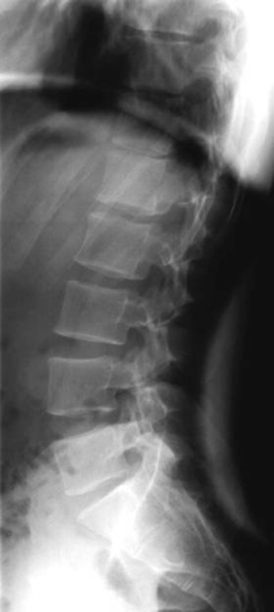 <p>Normal lumbar lordosis</p>