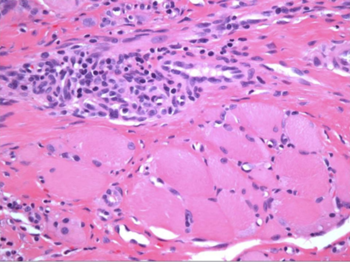 <p>the following describe the histopathological features of what?</p><p>-numerous eosinophils</p><p>-inflammation of skeletal muscle</p><p>-granulation tissue</p>
