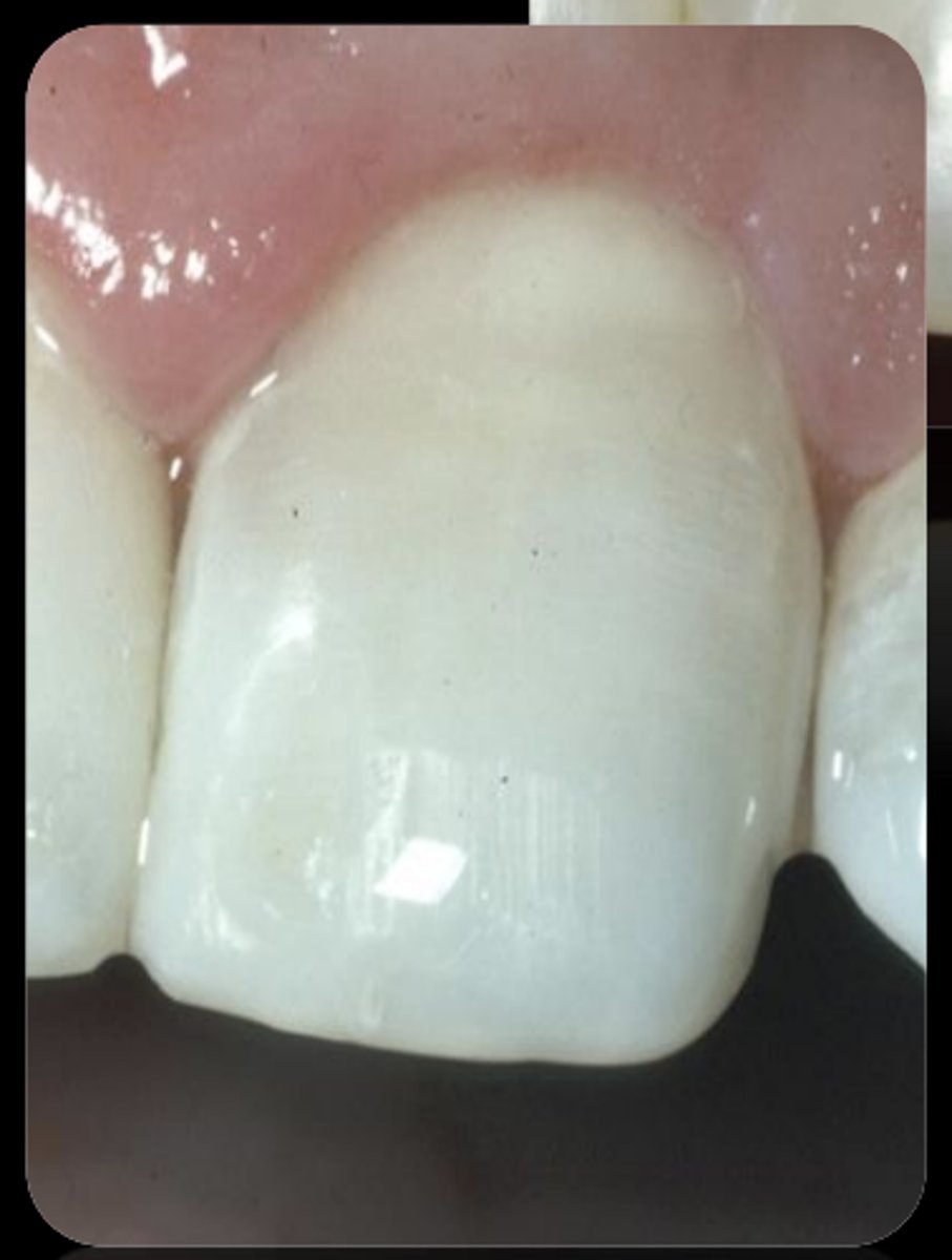<p>Class V - good interface with dentin and cementum</p><p>Class I and II - more common in older adults and pediatric patients</p><p>Class III</p><p>- mainly in areas not under high loads</p>