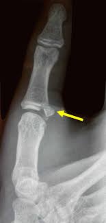 fragment of bone chipped away from the main bone
