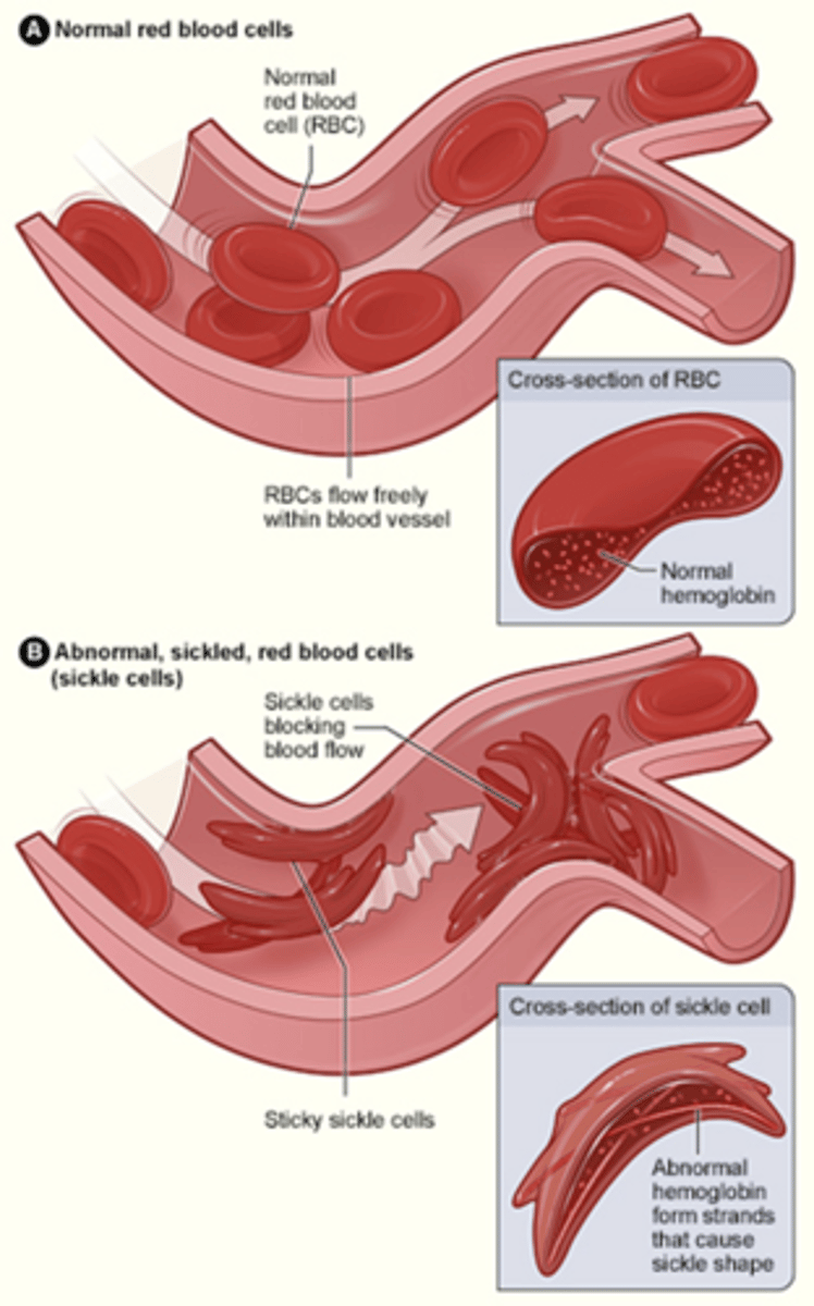 <p>Genetic disease in which red blood cells do NOT bind O2 properly; take on sickle (rather than disc) shape and become trapped in capillaries</p><p>Caused by a single amino acid substitution mutation in the hemoglobin gene (Glu (hydrophilic/polar) -> Val (hydrophobic/nonpolar))</p><p>- This change causes hemoglobin to aggregate</p><p>Leads to a lack of O2</p><p>Dangerous/deadly when hemoglobin is deoxygenated</p>