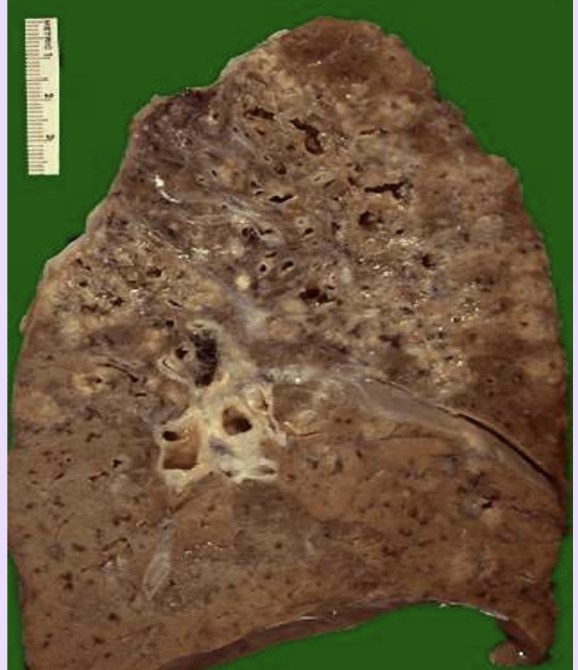 <p>Granulomatous inflammation</p>