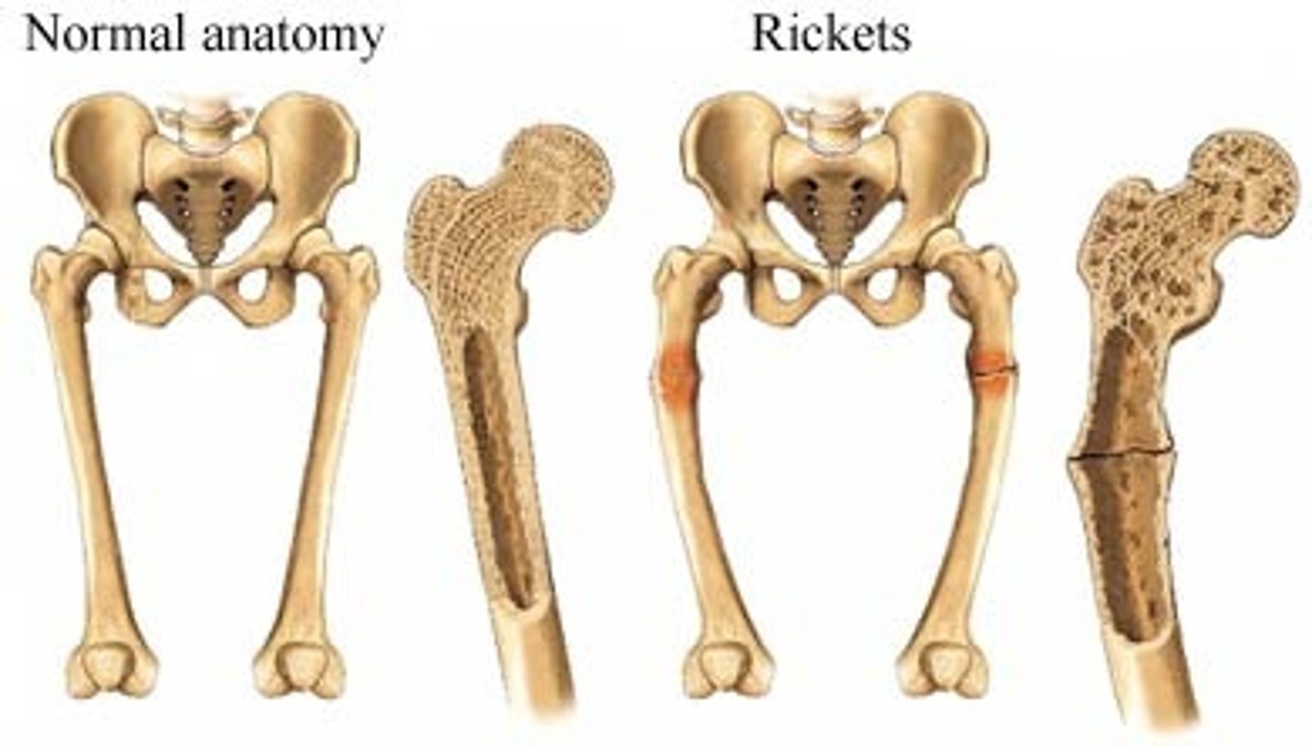 <p>rickets, osteomalacia<br>-a persons ability to build strong bones is lowered<br>(Disney Knees)</p>