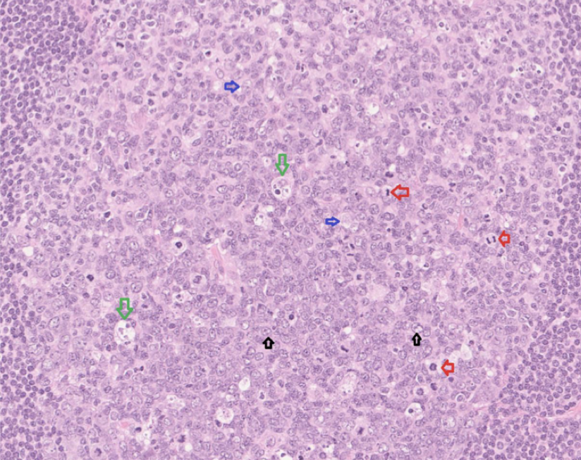 <p><strong>Centerocyt</strong>: Finns i dark zone. Små mröka celler med lite cytoplasma. De är kantiga. </p><p><strong>Centeroblast (svart)</strong>: Större och blekare celler med 1-3 nukleoler längst cellmembranet. </p><p><strong>FDC (blå)</strong>: Blekt kromatin, EN central nukleol. Cellerna runtomkring har en tillplattad cellkärna. </p><p><strong>Tingible body makrofag (grön)</strong>: Stora och ljusa med flera celler inuti. </p><p>Det röda är mitoser. </p>