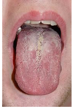 <p>white, powdery patches on the tongue / in mouth</p>