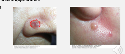 <ul><li><p><strong>Papule or nodule</strong> with <strong>raised/rolled borders</strong> and <strong>central erosion or ulceration</strong></p></li><li><p><strong>Waxy, pearly, or translucent</strong> surface appearance</p></li><li><p><strong>Telangiectatic vessels</strong> (visible surface blood vessels)</p></li></ul><p></p>