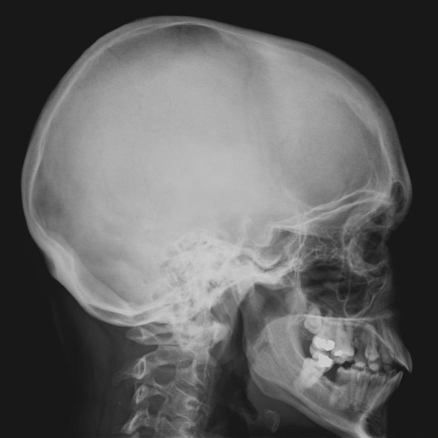 <p>ant and pos clinoid processes</p><p>supraorbital margins and wings of sphenoid superimped</p><p>superimped cranial and facial structures</p>