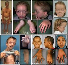 <p>caused by a deletion in 22q11.2</p><p>phenotypes:</p><p>-cleft palate</p><p>-velvo-palatal insufficiency</p><p>-heart malformations</p><p>-learning disabilities</p>