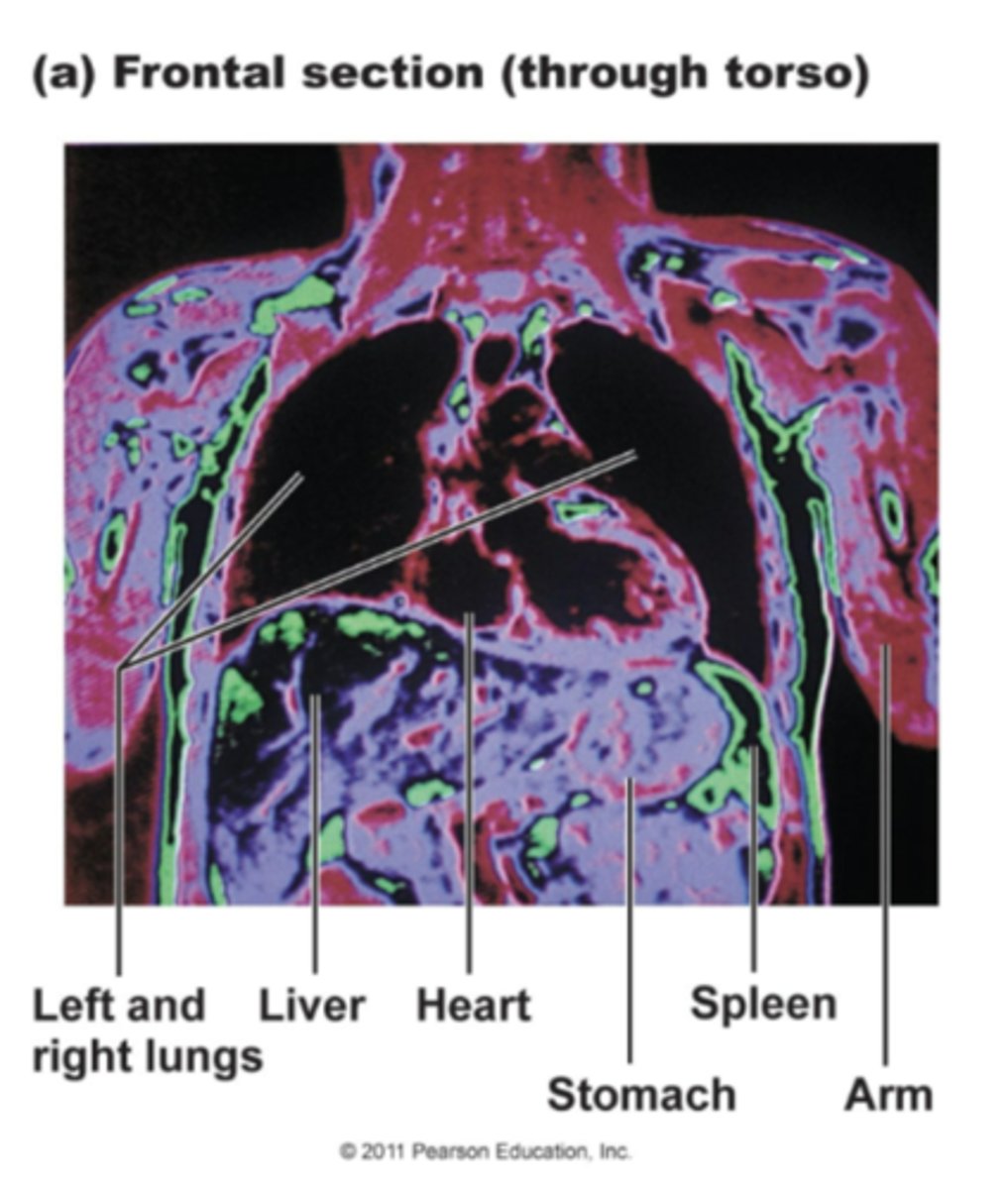 <p>Also called a 'Frontal' section, this body plane is capable of revealing a wide area. This image is taken of the thorax, and is cut parallel to both shoulder blades(scapulae).</p>