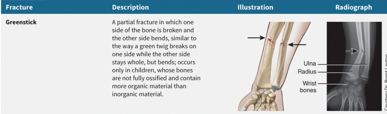 <p>Small linear break in bone cortex</p>