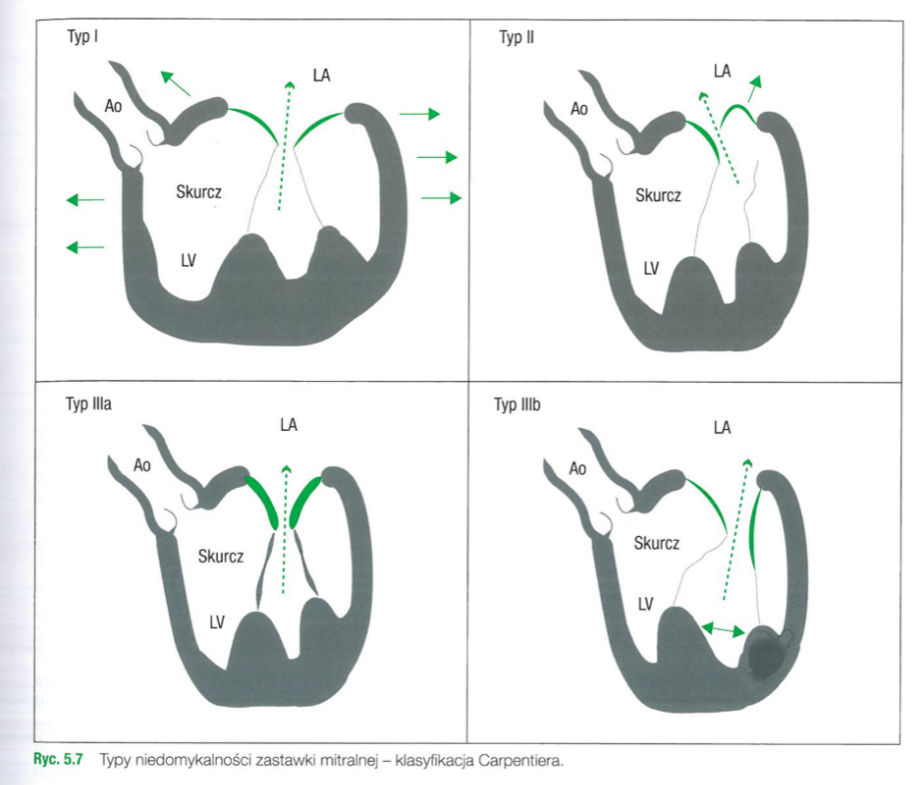 <ol><li><p><span>﻿﻿﻿Typ I - niedomykalnosc zwiazana z poszerzeniem pierscienia mitralnego, bez zmian organicznych ptatków zastawki (np. w kardiomiopatii rozstrzeniowej).</span></p></li><li><p><span>﻿﻿﻿Typ II - niedomykalnosé zwiazana z nadmierna ruchomoscia platków, wtórna do zmian w ptatkach (np. wypadanie ptatka zastawki mi-tralnej) lub w aparacie podzastawkowym (np. pekniecie nici sciegnistej, miesnia brodawko-watego).</span></p></li><li><p><span>﻿﻿﻿Typ III - niedomykalnosé zwiazana z ograniczonym ruchem platków:<br>Illa - zmiany w ptatkach (pogrubienie, zwap-nienie) i/lub aparacie podzastawkowym (zwtóknienie, skrócenie nici sciegnistych) ograniczajace ruch platków i prawidtowa ich koaptacje (np. w chorobie reumatycznej), IIIb - przebudowa i dylatacja lewej komory prowadzaca do przesuniecia na boki mie-sni brodawkowatych, co sprawia, ze sa one inaczej potozone w stosunku do ptatków za-stawki, zmienia kierunek pociagania ptat-ków i ostatecznie uposledza ich koaptacje (np. w kardiomiopatii niedokrwiennej). </span></p><ol><li><p><span>U chorych z przebudowa komory lewej wtórna do przebytego zawatu koniuszkowego lub zawatu sciany przedniej wystepuje symetryczna, centralna fala zwrotna (mięśnie brodawkowate przesunięte bocznie i w głąb komory lewej)</span></p></li><li><p><span>U chorych po zawale sciany dolnej, gdy remo-deling z akineza/dyskineza jest ograniczony do segmentów zawatowych - fala ma kierunek asymetryczny (regionalny remodeling komory obejmujacy gtównie miesien brodawkowaty tylno-przysrodkowy).</span></p></li></ol></li></ol><p></p>
