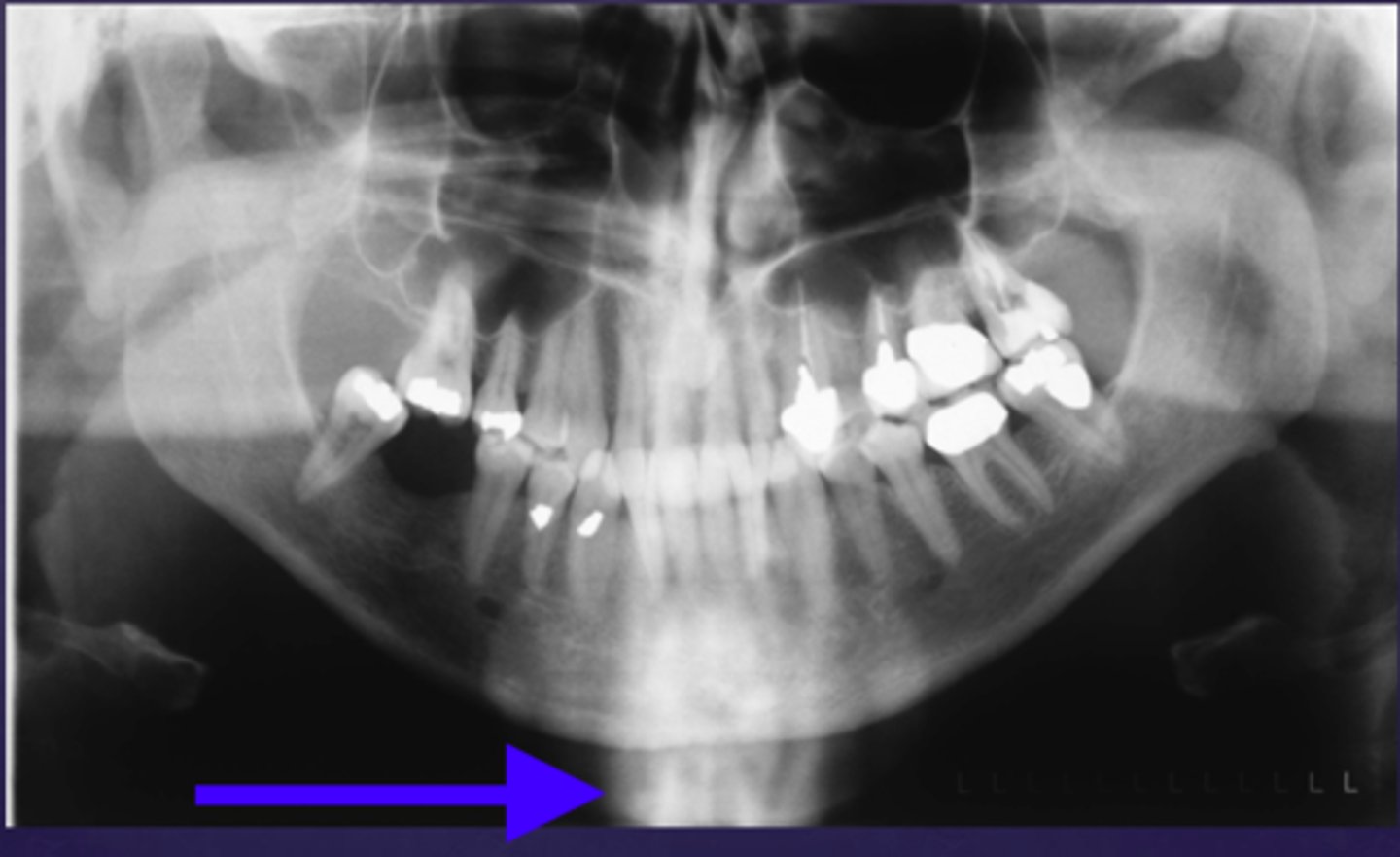 <p>the blue arrow is pointing to what type of image of the cervical vertebrae?</p>