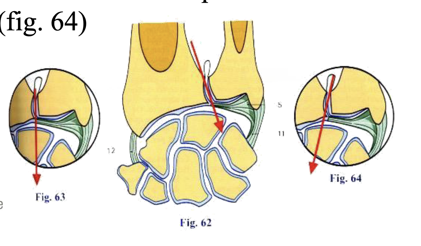 <p>• Plus fréquent (direction distale et médiale) (fig. 62)</p><p>• Plus rarement : vertical (fig. 63)</p><p>• Exceptionnellement : oblique en direction distale et latérale (fig. 64)</p>