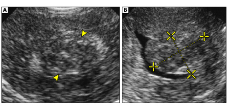 <p><strong>Uterine Fibroids: Labs and Imaging</strong></p><p>-Labs → ___ to rule out pregnancy, may have iron deficiency _______</p><p>-Imaging → pelvic ___________ is the first imaging study of choice</p><ul><li><p>Step 2 → saline infusion sonography or hysteroscopy for patients with suspected submucous fibroids or those desiring _________</p></li><li><p>Step 3 → ___ may be needed when complex intervention is planned </p></li></ul><p>-If ____________ is seen in a fibroid on an ultrasound, that implies that it has degenerated </p><p></p>