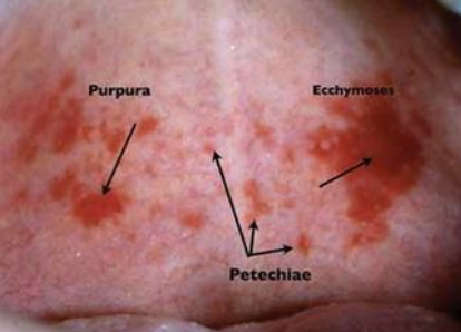 <p>What is a hematoma?</p>