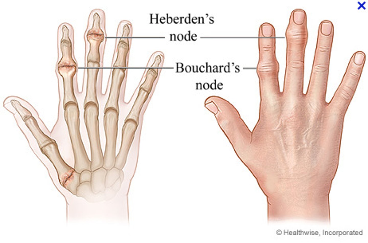 <p>osteoarthritis</p>