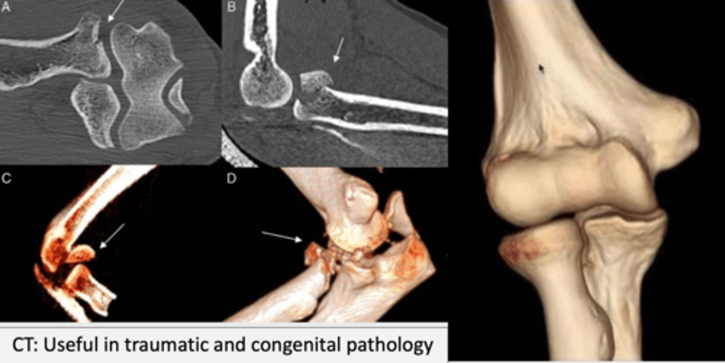 <p>CT (Computed Tomography) is the most used technique for a detailed assessment of the elbow's radiological anatomy and the study of pathologies, mainly traumatic.</p>