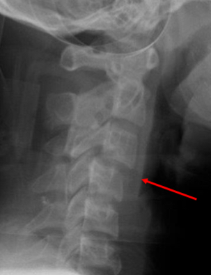 <ul><li><p>flexion/distraction/rotation injury</p></li><li><p>Inferior articulator facet of the vertebra above moves over the superior articular facet below and becomes locked</p></li><li><p>Commonly impacts c4/c5 and c5/c6                          </p></li></ul><p></p>
