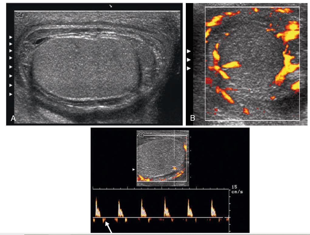 <p><strong>(A) Severe _________ in patient with scrotal pain, swelling, and edema. </strong></p><p>The testis is swollen against a rigid tunica albuginea. Scrotal skin thickening is evident.</p><p> (B) Power Doppler shows hyperemic perfusion surrounding the testis but little intratesticular flow, despite the use of sensitive Doppler settings. </p><p>(C) Spectral Doppler waveform of an intratesticular artery demonstrates a high- resistance waveform. Reversed flow is seen in diastole (arrow). This is a serious finding, indicating threatened infarction.</p>