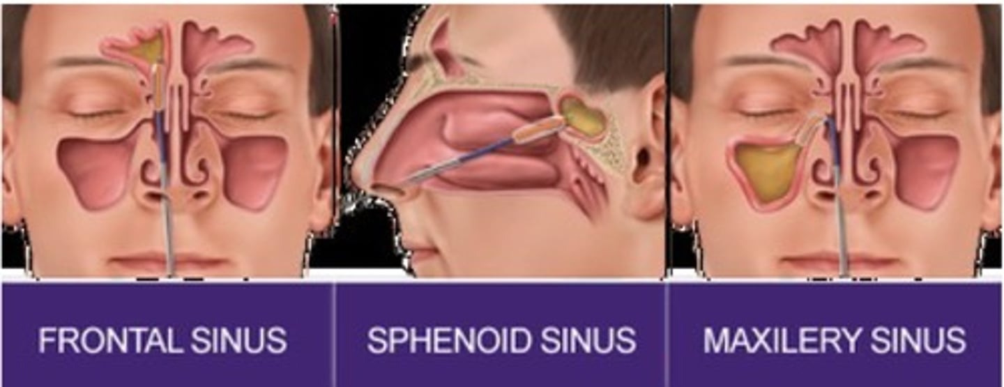 <p>1. Frontal</p><p>2. Sphenoid</p><p>3. Maxillary</p>