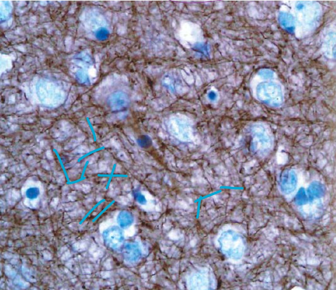 <p>MO, IHC neurofilament </p><p>Neurites, prolongement cytoplasmique des neurones</p>