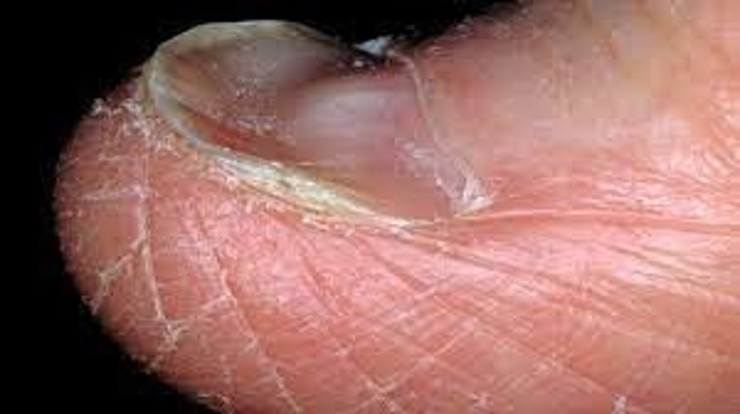 <p>-Nails that have lost their convexity, becoming flat or concave in shape</p><p>-Opposite of nail clubbing</p><p>Causes:</p><p>-Iron deficiency anemia</p><p>-Polycythemia</p><p>-Coronary disease</p><p>-Syphilis</p><p>-Strong alkalis (soaps)</p><p>-Petroleum products</p><p>-Plummer Vinson's Syndrome</p>