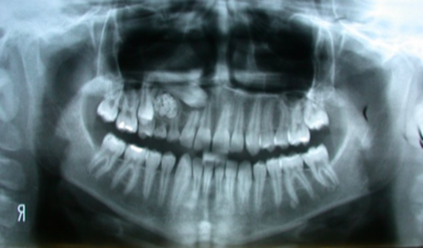 <p>What is the cause of the tooth displacement/impaction in this patient?</p>