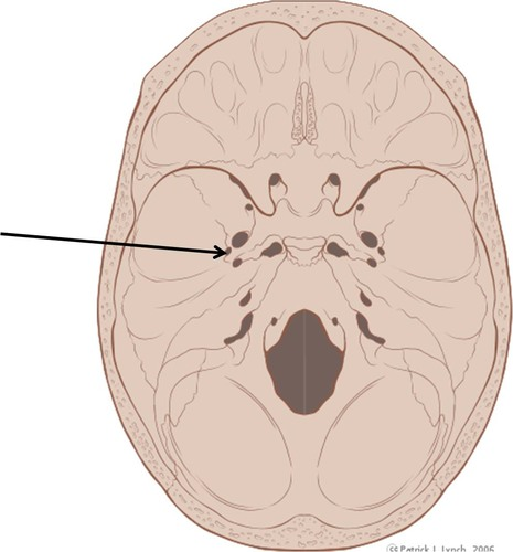 <p>Opening lateral to the foramen ovale through which the middle meningeal artery passes</p>