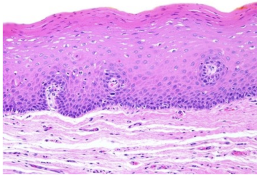 <p><mark data-color="red" style="background-color: red; color: inherit">A 68-year-old man presented with a painless white patch over the edentulous mandibular gingiva. He had a 50-year history of heavy smoking, and a history of alcoholism. A biopsy was taken and the microscopic appearance is shown in the attached figure. What is the most likely diagnosis in this patient?</mark></p><p></p><p><mark data-color="red" style="background-color: red; color: inherit">Erythroplakia</mark></p><p><mark data-color="red" style="background-color: red; color: inherit">&nbsp;</mark></p><p><mark data-color="red" style="background-color: red; color: inherit">Squamous cell carcinoma</mark></p><p><mark data-color="red" style="background-color: red; color: inherit">&nbsp;</mark></p><p><mark data-color="red" style="background-color: red; color: inherit">Verrucous carcinoma</mark></p><p><mark data-color="red" style="background-color: red; color: inherit">&nbsp;</mark></p><p><mark data-color="red" style="background-color: red; color: inherit">Leukoplakia</mark></p><p><mark data-color="red" style="background-color: red; color: inherit">&nbsp;</mark></p><p><mark data-color="red" style="background-color: red; color: inherit">Pyogenic granuloma</mark></p>