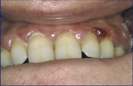 <p>A small blister <5mm</p>