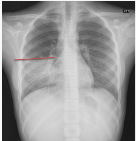 <p>When there is an increased density in the patient’s right lung that obscures the right heart border</p>