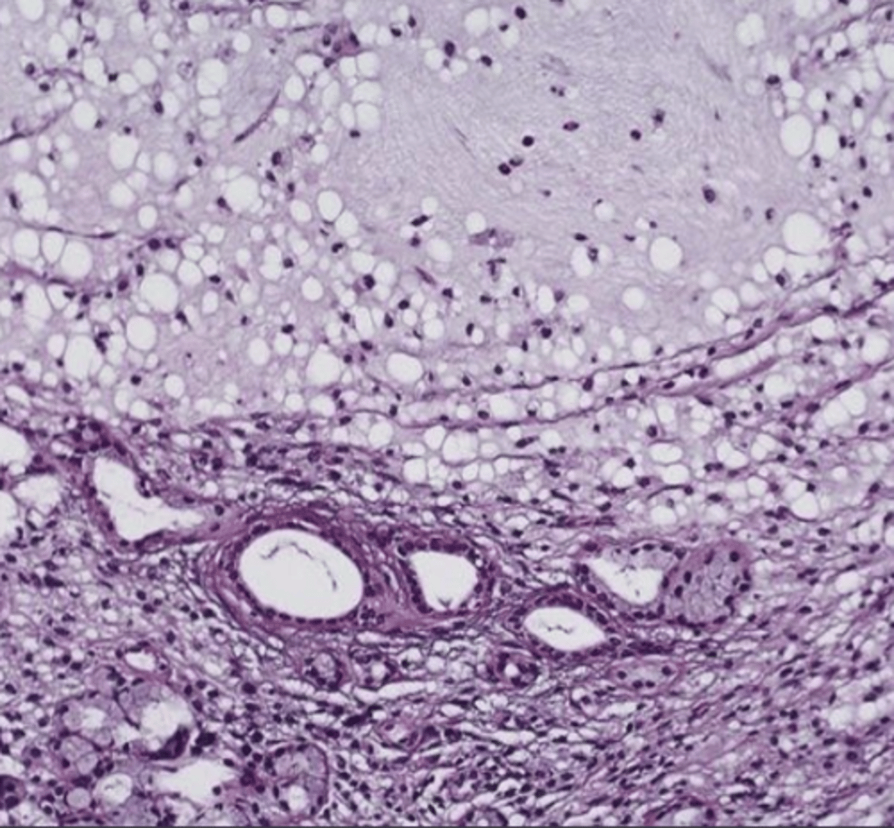 <p>These histology characteristics are indicative of what oral pathology?</p><p>-Granulation tissue</p><p>-Spilled mucin</p><p>-inflamed salivary gland tissue </p>