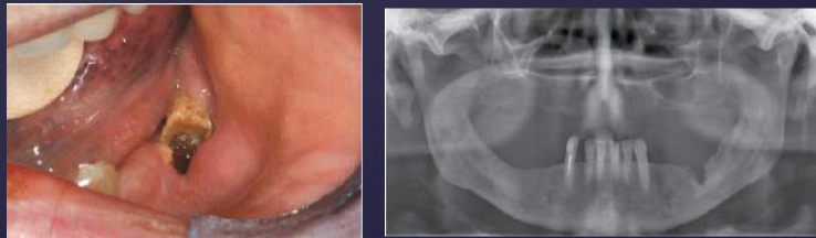 <p><strong>osteoradionecrosis</strong>: damage to vasculature of periosteum + cortical bone, destruction of osteoblasts </p>