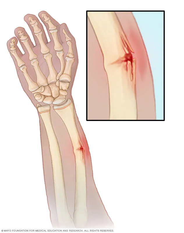 <ul><li><p>an incomplete fracture that passes only partway through the shaft of a bone but may still cause substantial angulation </p></li><li><p>occurs in children </p></li></ul><p></p>