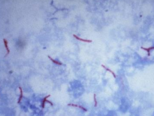 <ul><li><p><strong>Isolated from soil or bodies of water</strong></p></li><li><p><span style="color: rgb(136, 136, 136);"><strong>Et:<u> </u></strong></span><strong><u>Deep skin infection</u></strong> of M. fortuitum, M. chelonae, M. abscessus, M. smegmatis; soil, water; opportunistic, trama</p></li><li><p><span style="color: rgb(136, 136, 136);"><strong>ID: </strong></span><span style="color: red;"><strong><u>acid fast,</u></strong></span> affinity for fat</p></li><li><p><span style="color: rgb(136, 136, 136);"><strong>Cs:</strong> </span><strong>panniculitis</strong>, lobar pneumonia, disseminated dx, alopecic nodules, <u>draining tracts,</u> thin skin, swellings</p><ul><li><p>Neck, shoulders, flank, dorsum, <strong>Nearby subcutis thickens(cats)</strong></p></li><li><p><strong>Not painful/pruritic&nbsp;</strong></p></li><li><p><strong>Lipid vacuole </strong></p><img src="https://knowt-user-attachments.s3.amazonaws.com/747358df-bc24-462e-bf0a-6d2788f81505.png" data-width="50%" data-align="center"></li></ul></li><li><p><span style="color: rgb(136, 136, 136);"><strong>Dt:<u> </u></strong></span><u>cytology (AFB staining)</u>, <u>culture</u>,<u> deep biopsy</u></p></li><li><p><span style="color: rgb(136, 136, 136);"><strong>Tx: </strong></span><strong>Sx removal,</strong> <strong><u>clarithromycin</u></strong>, doxycycline,<strong> FQ</strong>, amikacin, clean w/ bleach</p><ul><li><p>some need life long tx</p></li></ul></li></ul><p></p>