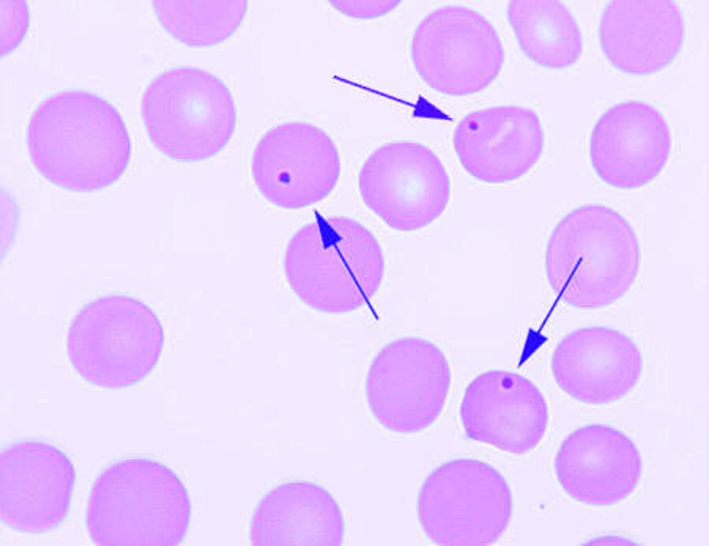 <p>Single erythrocyte inclusions which are large, round, smooth and purplish-blue staining are most likely:</p><p>A. Howell-Jolly bodies</p><p>B. Heinz bodies</p><p>C. Basophilic stippling</p><p>D. Cabot rings</p>