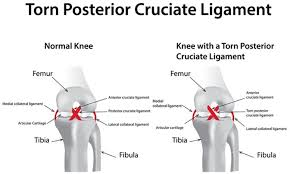 <p>posterior cruciate ligament </p>
