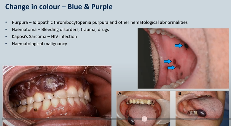 <ol><li><p><strong>Purpura </strong>– Idiopathic <em>thrombocytopenia </em>purpura and other hematological abnormalities </p></li><li><p><strong>Haematoma </strong>– Bleeding disorders, trauma, drugs</p></li><li><p><strong>Kaposi’s Sarcoma </strong>– HIV infection </p></li><li><p><strong>Haematological </strong>malignancy</p></li></ol><p></p>