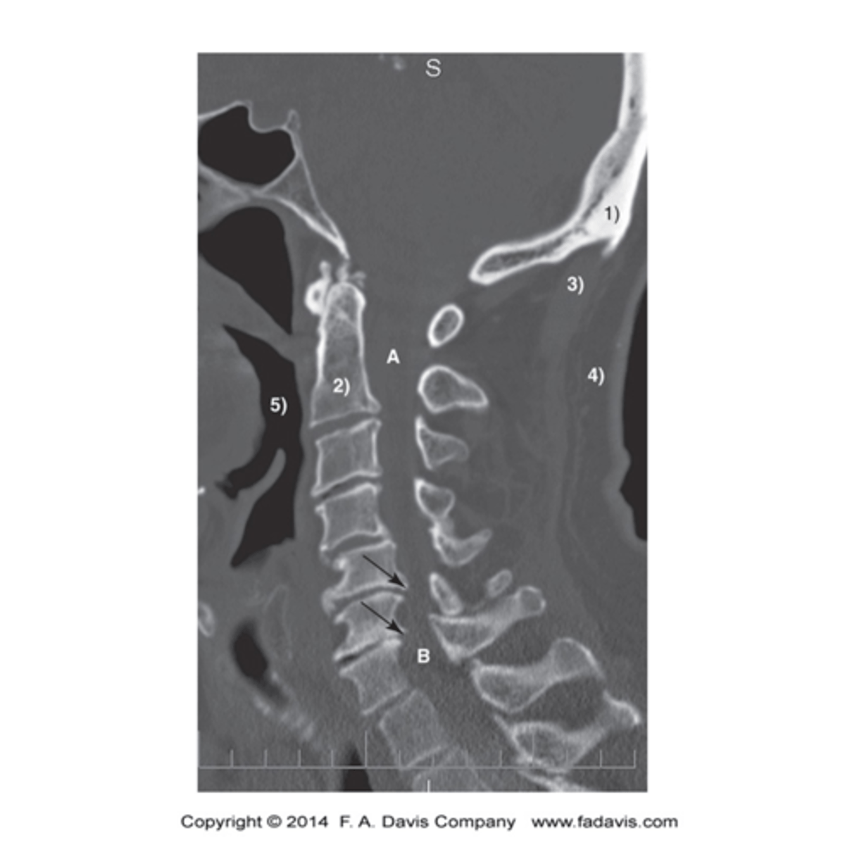 <p>- It is a highly detailed depiction of normal anatomy and pathological processes in cross section</p><p>- It is less time consuming than MRI or US</p><p>- Allows for accurate measurements of osseous alignment in any plane</p><p>- It is usually less expensive than MRI</p><p>- It is less problematic than MRI for patients with claustrophobia</p>