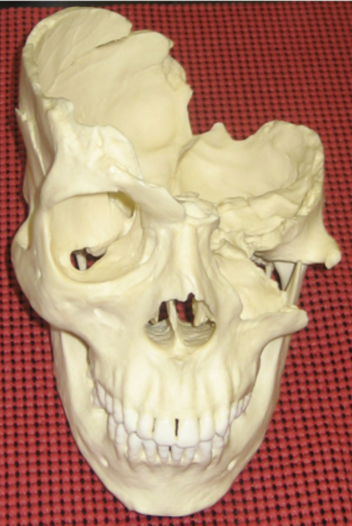 <p>What type of trauma caused this injury?</p>