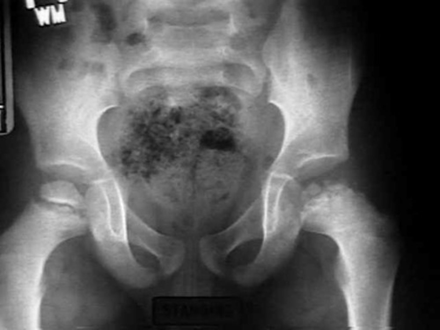 <p>Legg-Calve-Perthes disease</p><p>- underlying throbophilia may be predisposing factor</p>