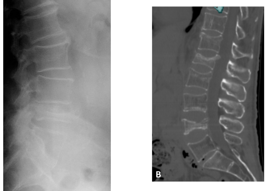 <p>= maladie généralisée du squelette, caractérisée par une résistance osseuse (= densité + qualité) diminuée prédisposant à un risque élevé de fracture (patho, trauma et contrainte) </p><p>Diag par mesure de la DMO </p><p>Bilan radio du rachis dorso-lombaire en cas de perte de taille significative (>4cm)  </p>