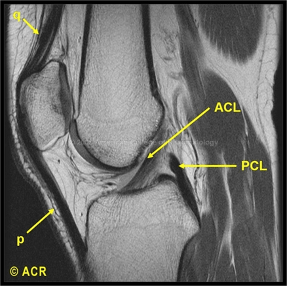 <p>MRI is a cross sectional imaging technology that uses a magnetic field and radio frequency signals to cause hydrogen nuclei to emit their own signals, which then are converted to images by a computer </p>