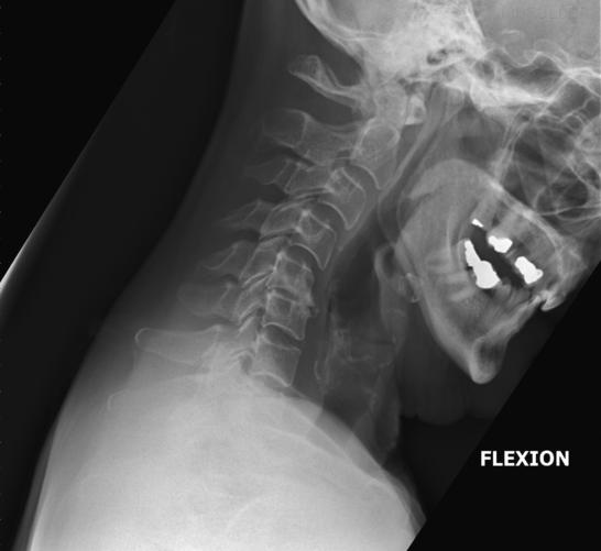 <p>Superimposed mandibular rami.</p>