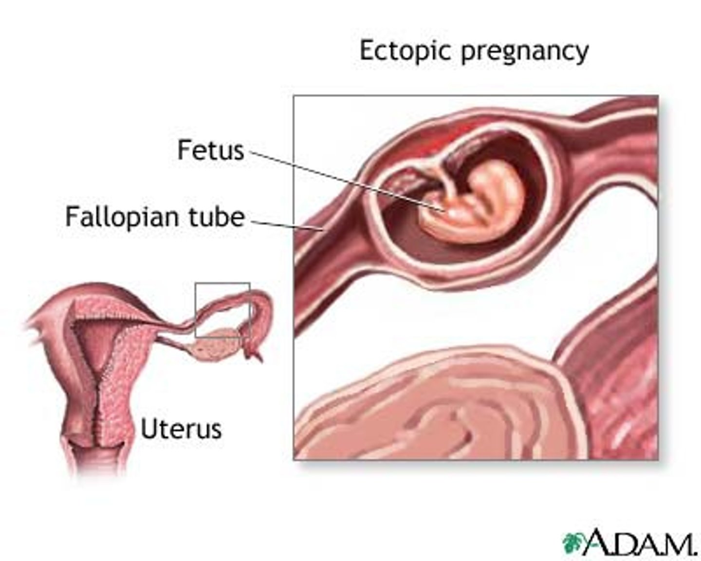 <p>pregnancy occurring outside uterus, commonly in fallopian tube (salpingocyesis)</p>