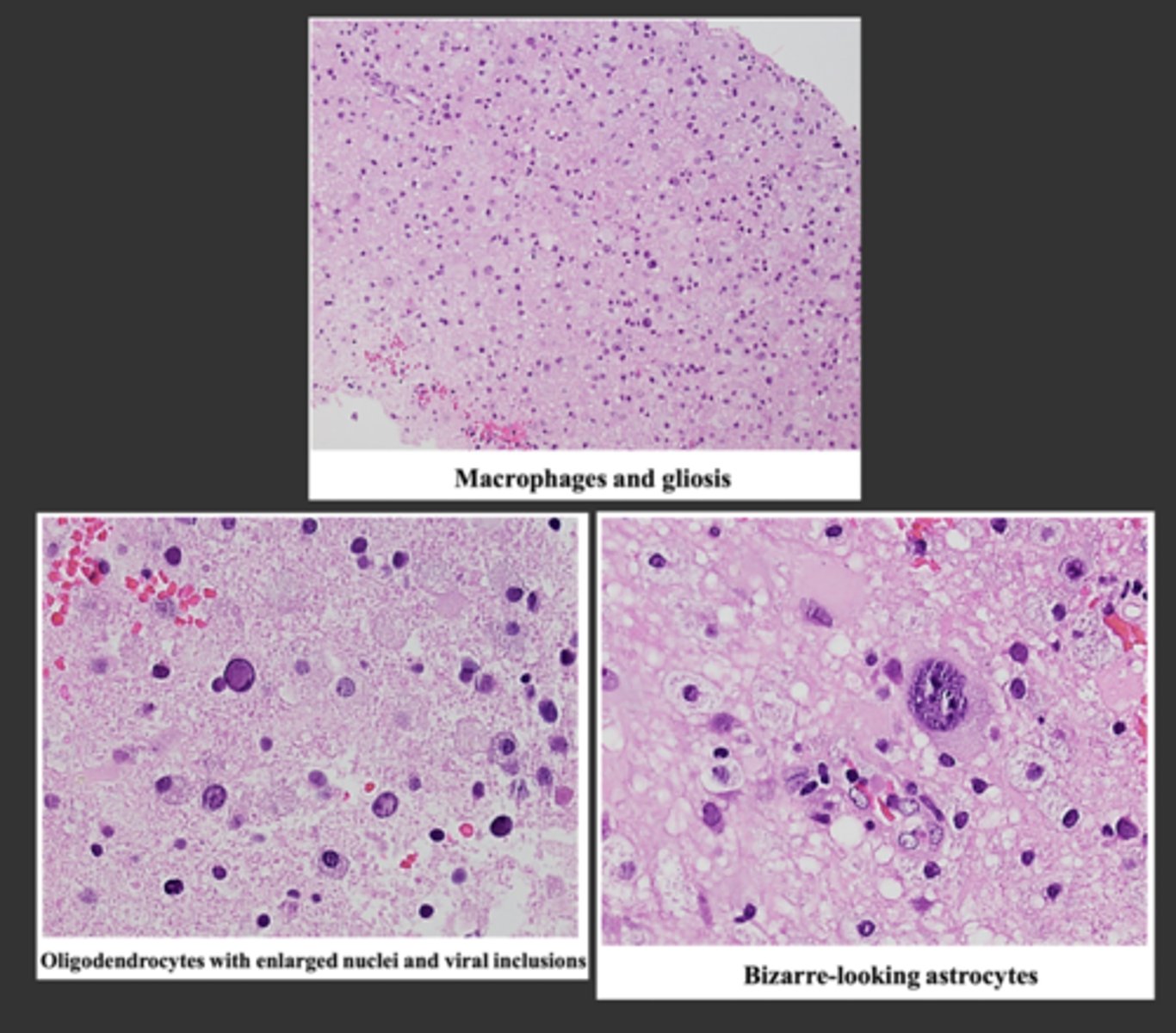 <p>microscopic features of progressive multifocal leukoencephalopathy (PML):</p>