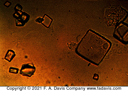 <p>name this crystal, what disease is it associated with? What is its ph? Normal or abnormal?</p>