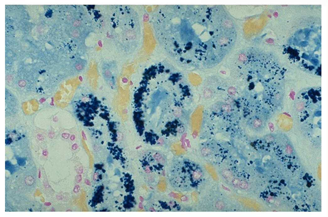 <p>Prussian blue iron stain on a section of the kidney. The renal tubules contain large amounts of hemosiderin. This is observed in what kidney disorder?</p>